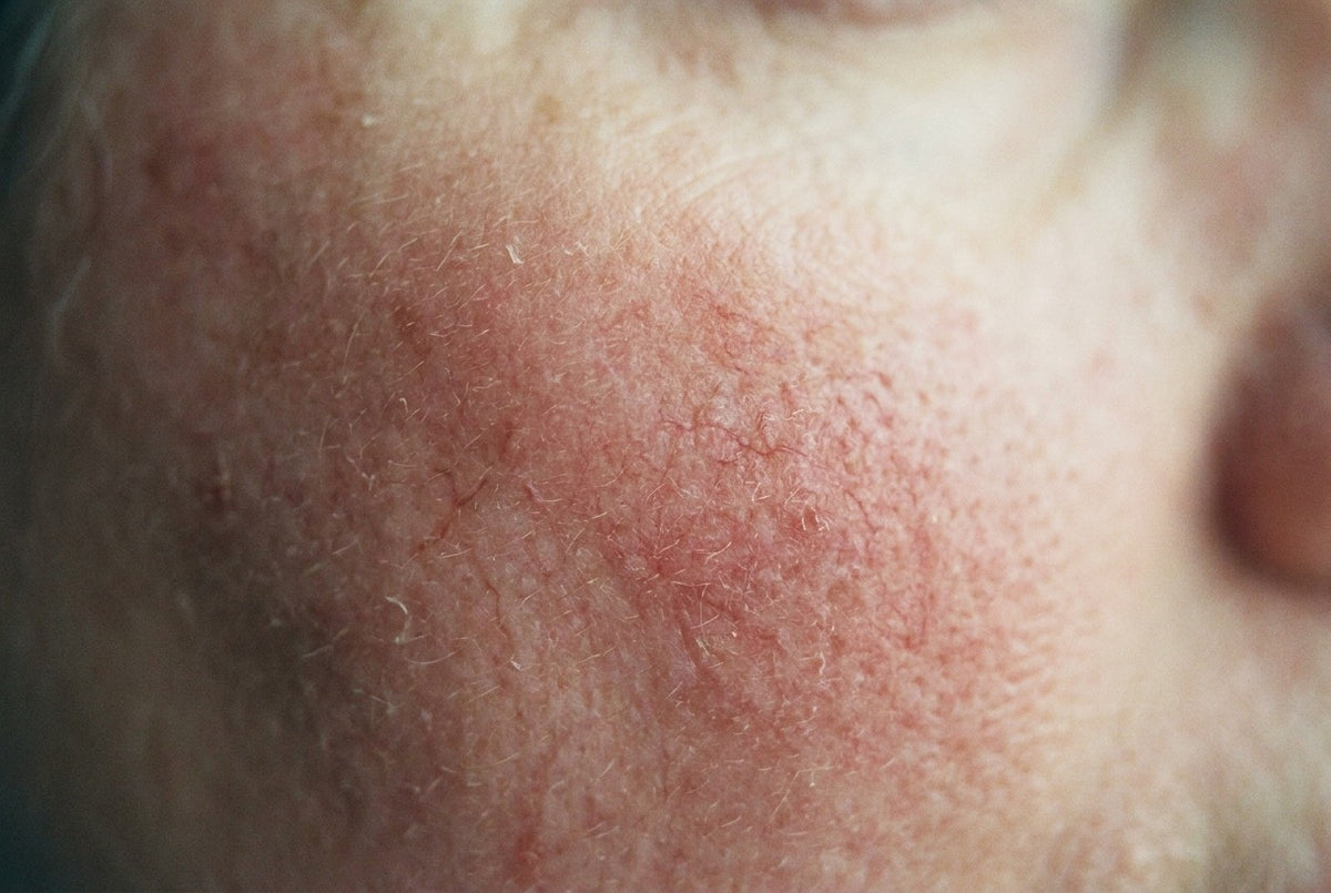 Extreme macro of a cheek: unretouched skin showing diffuse redness and fine branching telangiectasia — thin red vessels just under the surface.
