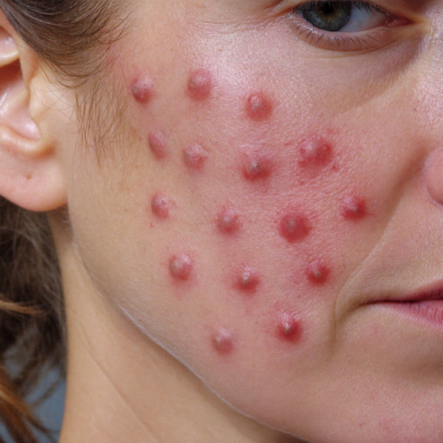 Bumps (not acne)