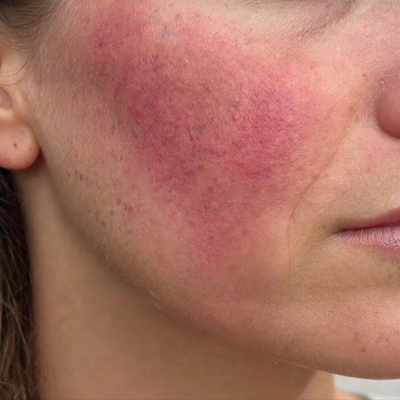 Constant redness