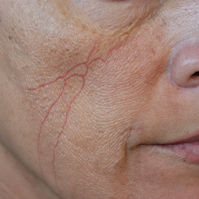 Little red veins